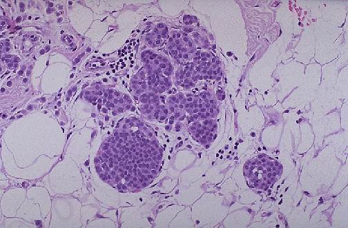 Carcinoma lobulillar in situ - <div style=